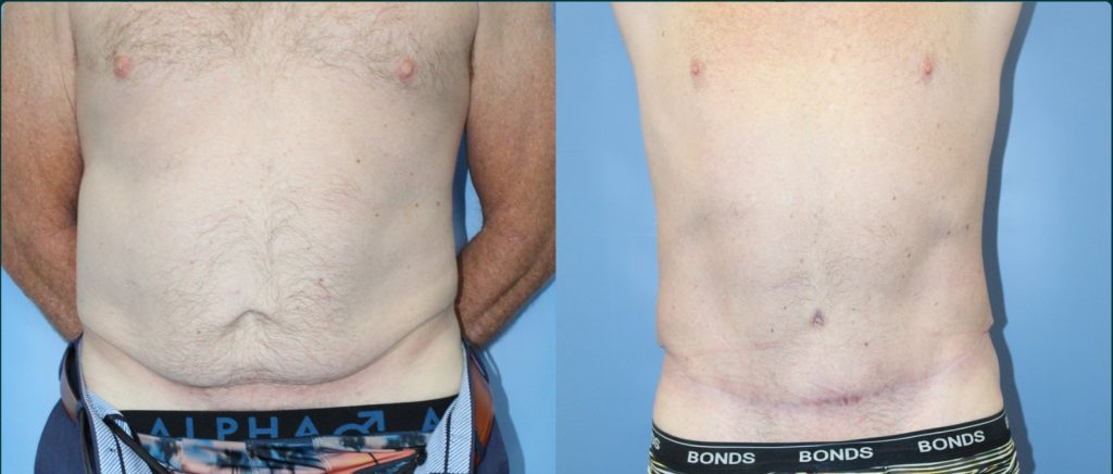 Skin removal after weight loss (male) before and after, male patient, case ABD-L03, Dr Rohit Kumar, Sydney