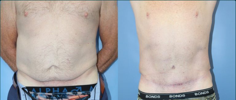 Skin removal after weight loss (male) before and after, male patient, case ABD-L03, Dr Rohit Kumar, Sydney