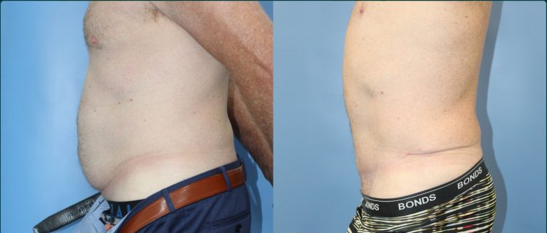 Skin removal after weight loss (male) before and after, male patient, case ABD-L03, Dr Rohit Kumar, Sydney