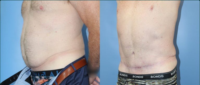 Skin removal after weight loss (male) before and after, male patient, case ABD-L03, Dr Rohit Kumar, Sydney