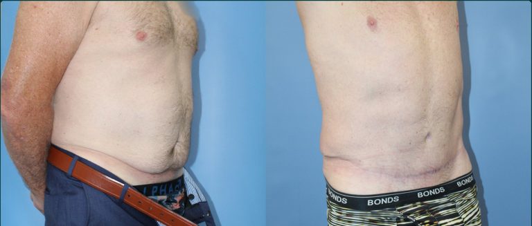 Skin removal after weight loss (male) before and after, male patient, case ABD-L03, Dr Rohit Kumar, Sydney