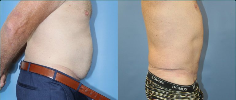 Skin removal after weight loss (male) before and after, male patient, case ABD-L03, Dr Rohit Kumar, Sydney