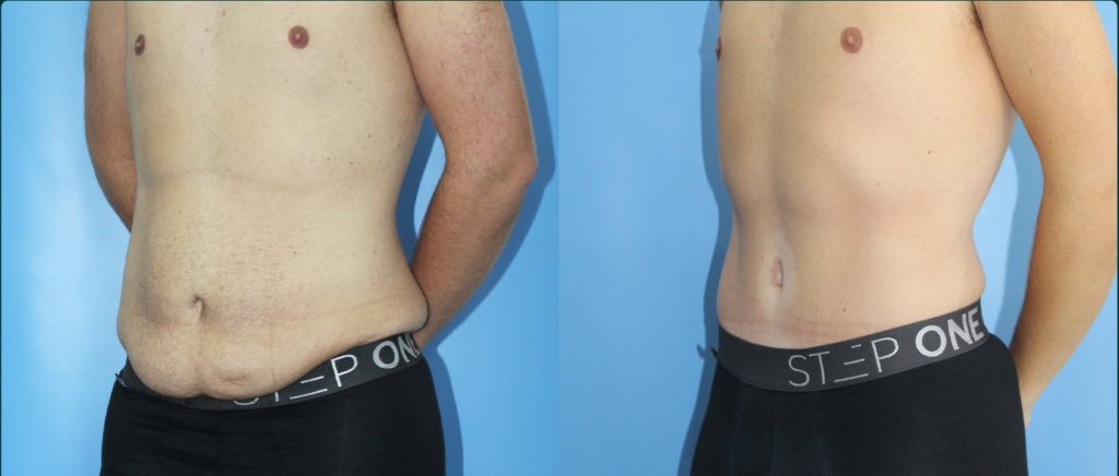 Skin removal after weight loss (male) before and after, male patient, case ABD-L09, Dr Rohit Kumar, Sydney