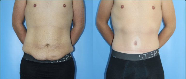 Skin removal after weight loss (male) before and after, male patient, case ABD-L09, Dr Rohit Kumar, Sydney