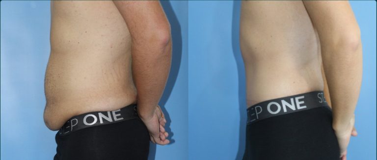 Skin removal after weight loss (male) before and after, male patient, case ABD-L09, Dr Rohit Kumar, Sydney