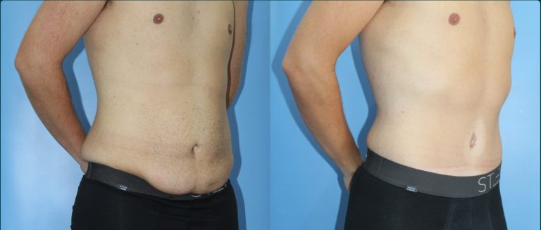 Skin removal after weight loss (male) before and after, male patient, case ABD-L09, Dr Rohit Kumar, Sydney