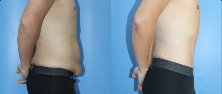 Skin removal after weight loss (male) before and after, male patient, case ABD-L09, Dr Rohit Kumar, Sydney