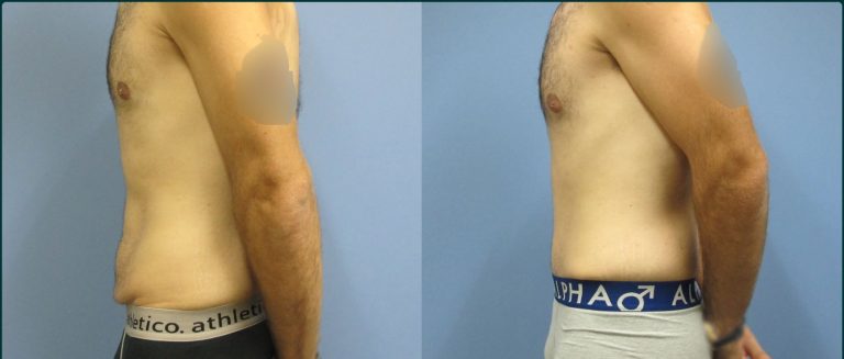 Skin removal after weight loss (male) before and after, 90° left view, male patient, case ABD-L23, Dr Rohit Kumar, Sydney