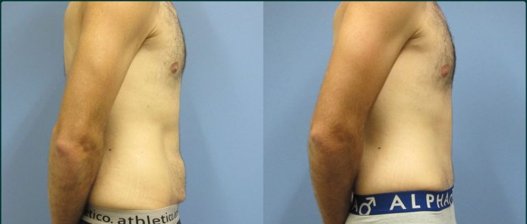 Skin removal after weight loss (male) before and after, 90° right view, male patient, case ABD-L23, Dr Rohit Kumar, Sydney