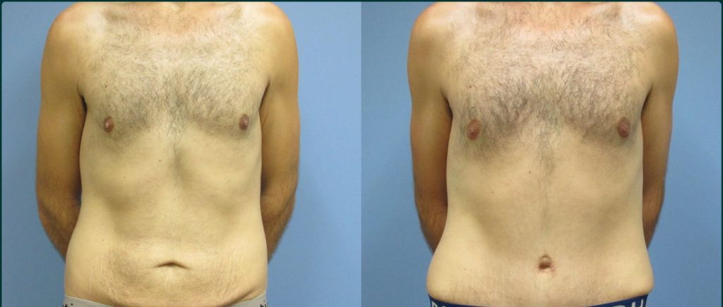 Skin removal after weight loss (male) before and after, front view, male patient, case ABD-L23, Dr Rohit Kumar, Sydney
