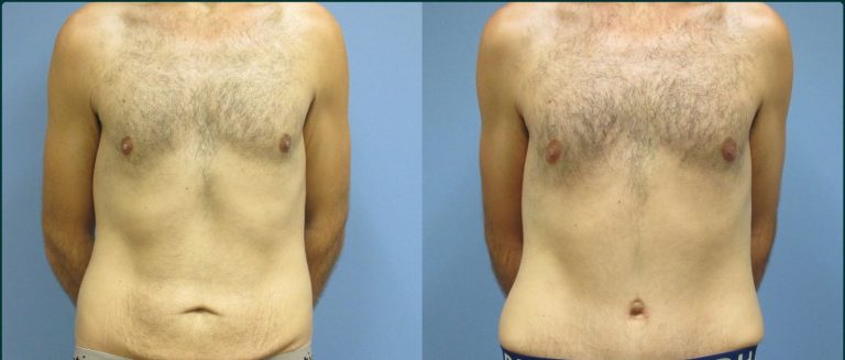 Skin removal after weight loss (male) before and after, front view, male patient, case ABD-L23, Dr Rohit Kumar, Sydney