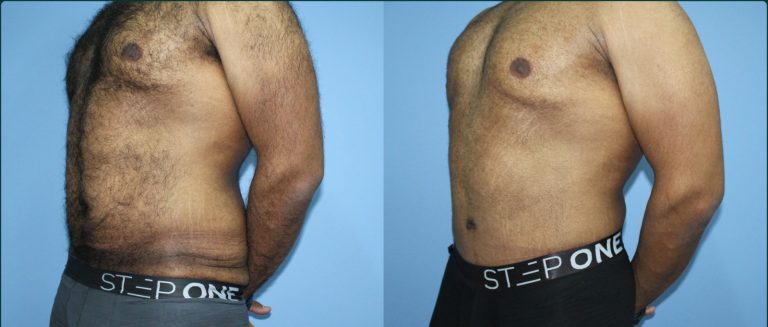 Skin removal after weight loss (male) before and after, 45° left view, male patient, case ABD-L29, Dr Rohit Kumar, Sydney