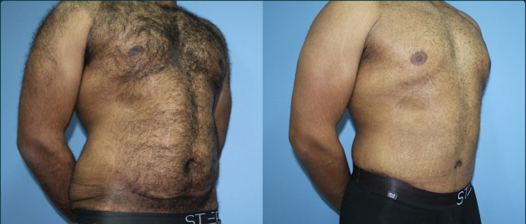 Skin removal after weight loss (male) before and after, 45° right view, male patient, case ABD-L29, Dr Rohit Kumar, Sydney