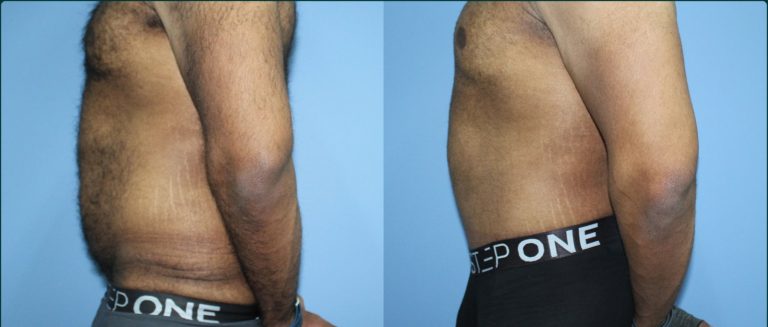 Skin removal after weight loss (male) before and after, 90° left view, male patient, case ABD-L29, Dr Rohit Kumar, Sydney
