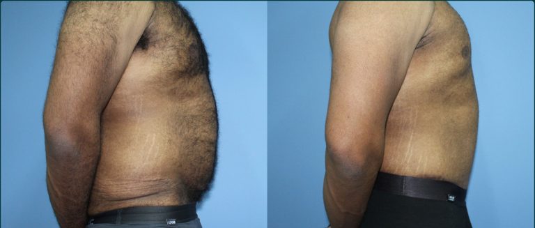 Skin removal after weight loss (male) before and after, 90° right view, male patient, case ABD-L29, Dr Rohit Kumar, Sydney
