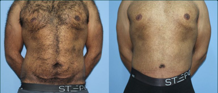 Skin removal after weight loss (male) before and after, front view, male patient, case ABD-L29, Dr Rohit Kumar, Sydney
