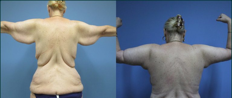 Arm lift (brachioplasty) before and after, back view, female patient, case ARM-L01, Dr Rohit Kumar, Sydney