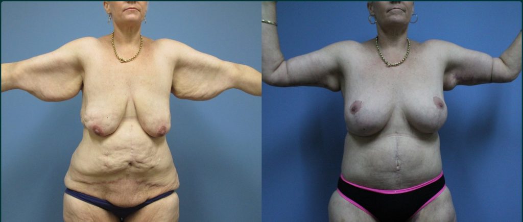 Arm lift (brachioplasty) before and after, front view, female patient, case ARM-L01, Dr Rohit Kumar, Sydney