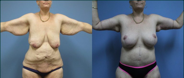 Arm lift (brachioplasty) before and after, front view, female patient, case ARM-L01, Dr Rohit Kumar, Sydney