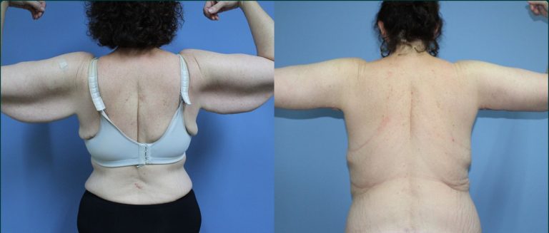 Arm lift (brachioplasty) before and after, back view, female patient, case ARM-L02, Dr Rohit Kumar, Sydney