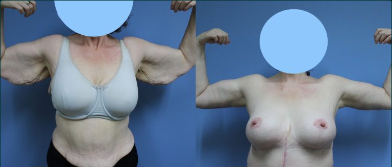 Arm lift (brachioplasty) before and after, front view, female patient, case ARM-L02, Dr Rohit Kumar, Sydney