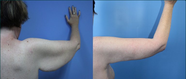 Arm lift (brachioplasty) before and after, back view, female patient, case ARM-L03, Dr Rohit Kumar, Sydney