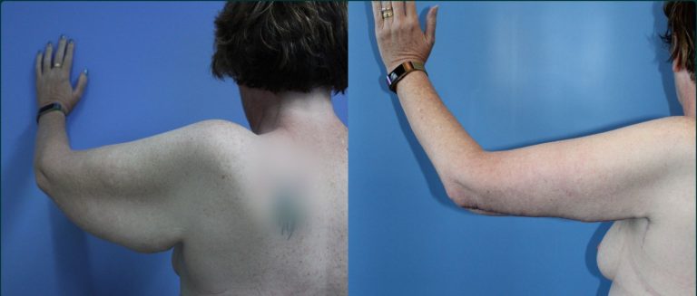 Arm lift (brachioplasty) before and after, back view, female patient, case ARM-L03, Dr Rohit Kumar, Sydney