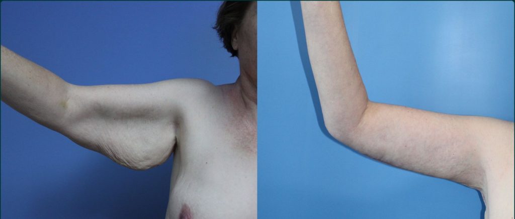 Arm lift (brachioplasty) before and after, front view, female patient, case ARM-L03, Dr Rohit Kumar, Sydney