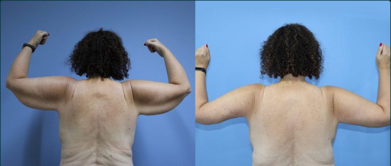 Arm lift (brachioplasty) before and after, back view, female patient, case ARM-L04, Dr Rohit Kumar, Sydney