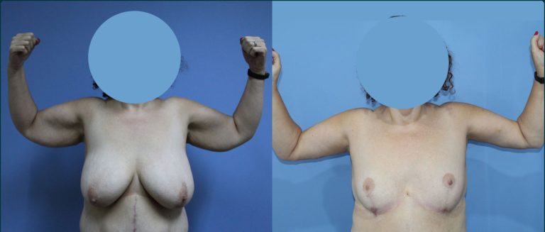 Arm lift (brachioplasty) before and after, front view, female patient, case ARM-L04, Dr Rohit Kumar, Sydney