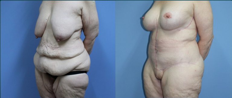 Arm lift (brachioplasty) before and after, female patient, case ARM-L04, Dr Rohit Kumar, Sydney