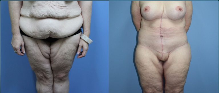Arm lift (brachioplasty) before and after, female patient, case ARM-L04, Dr Rohit Kumar, Sydney