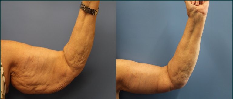 Arm lift (brachioplasty) before and after, 45° left view, female patient, case ARM-L05, Dr Rohit Kumar, Sydney