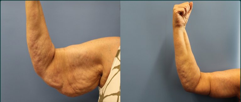 Arm lift (brachioplasty) before and after, 45° right view, female patient, case ARM-L05, Dr Rohit Kumar, Sydney