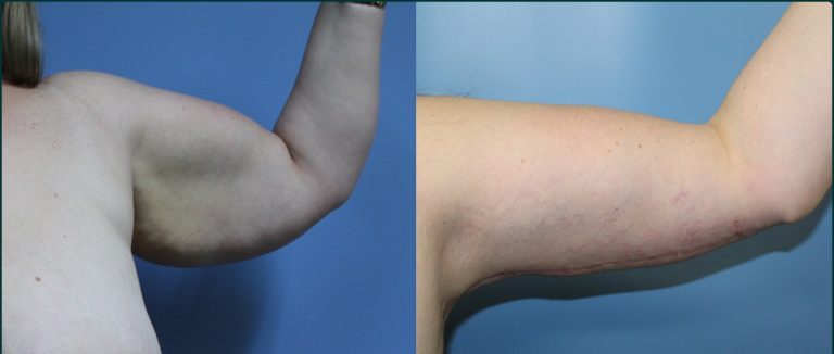 Arm lift (brachioplasty) before and after, 90° left view, female patient, case ARM-L06, Dr Rohit Kumar, Sydney