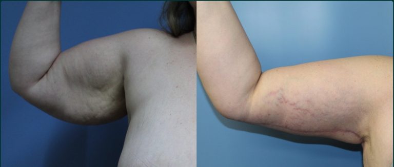 Arm lift (brachioplasty) before and after, 90° right view, female patient, case ARM-L06, Dr Rohit Kumar, Sydney