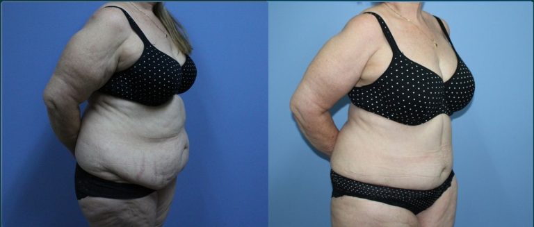 Arm lift (brachioplasty) before and after, 45° left view, female patient, case ARM-L07, Dr Rohit Kumar, Sydney