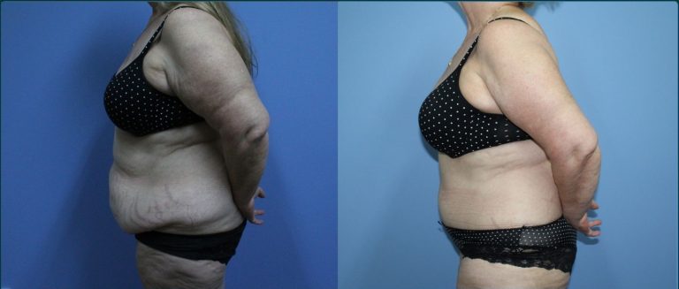 Arm lift (brachioplasty) before and after, 90° left view, female patient, case ARM-L07, Dr Rohit Kumar, Sydney