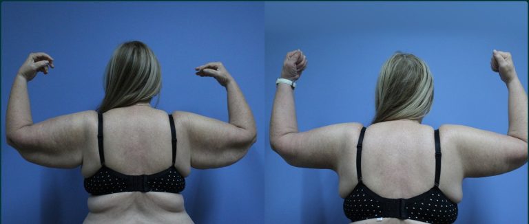 Arm lift (brachioplasty) before and after, back view, female patient, case ARM-L07, Dr Rohit Kumar, Sydney