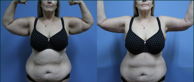 Arm lift (brachioplasty) before and after, front view, female patient, case ARM-L07, Dr Rohit Kumar, Sydney