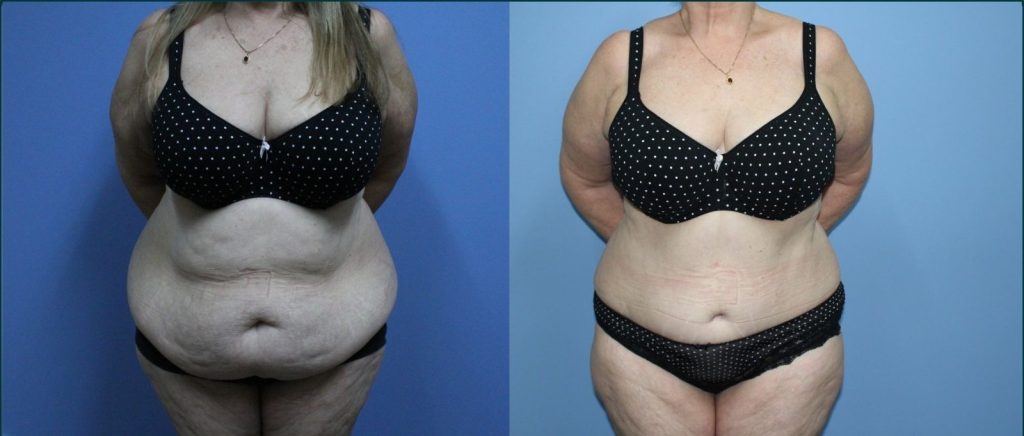 Arm lift (brachioplasty) before and after, front view, female patient, case ARM-L07, Dr Rohit Kumar, Sydney