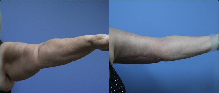 Arm lift (brachioplasty) before and after, female patient, case ARM-L08, Dr Rohit Kumar, Sydney