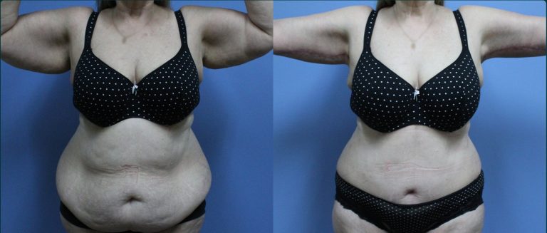 Arm lift (brachioplasty) before and after, female patient, case ARM-L08, Dr Rohit Kumar, Sydney