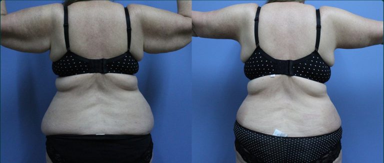 Arm lift (brachioplasty) before and after, female patient, case ARM-L08, Dr Rohit Kumar, Sydney
