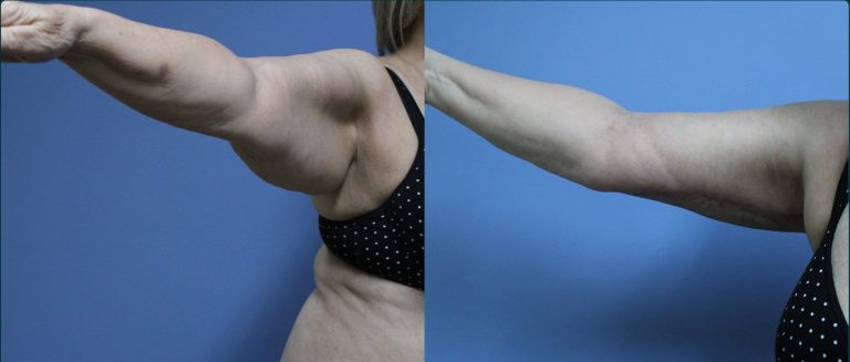 Arm lift (brachioplasty) before and after, female patient, case ARM-L08, Dr Rohit Kumar, Sydney