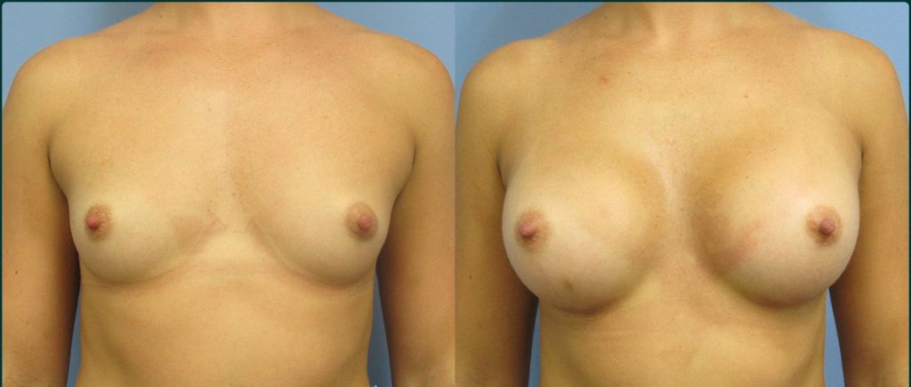 Breast augmentation before and after, female patient, case BAU-L01, Dr Rohit Kumar, Sydney