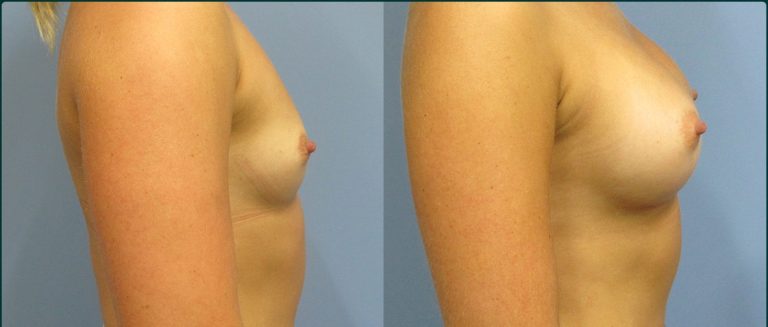 Breast augmentation before and after, female patient, case BAU-L01, Dr Rohit Kumar, Sydney