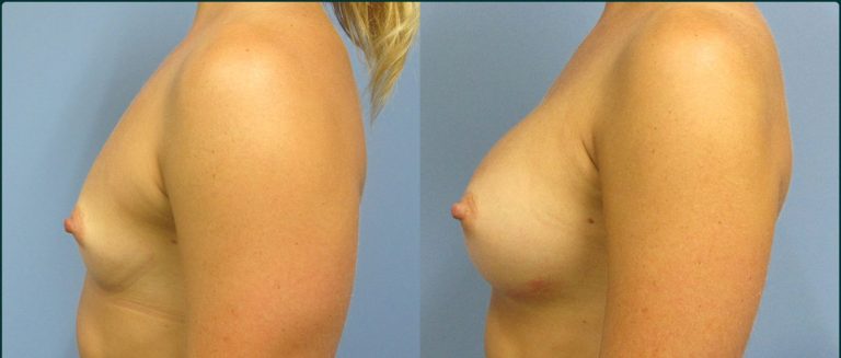 Breast augmentation before and after, female patient, case BAU-L01, Dr Rohit Kumar, Sydney