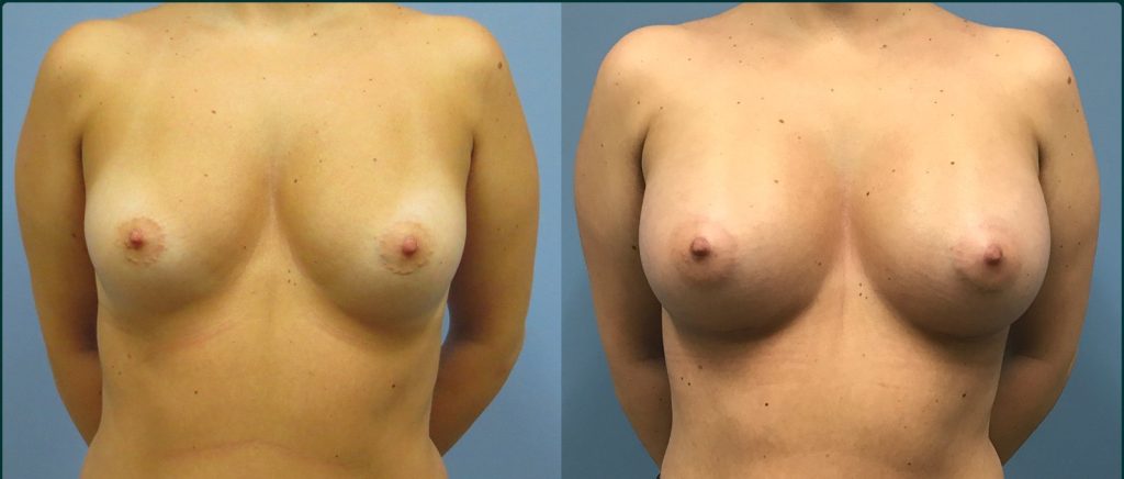 Breast augmentation before and after, female patient, case BAU-L02, Dr Rohit Kumar, Sydney