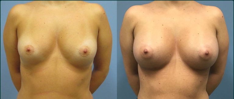 Breast augmentation before and after, female patient, case BAU-L02, Dr Rohit Kumar, Sydney